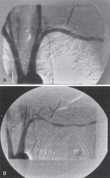 FIG 33.5, Digital intravenous axillosubclavian angiogram obtained in the supine (A) and sitting (B) positions to demonstrate thoracic outlet compressive changes (arrows), which are often seen only in the sitting position.