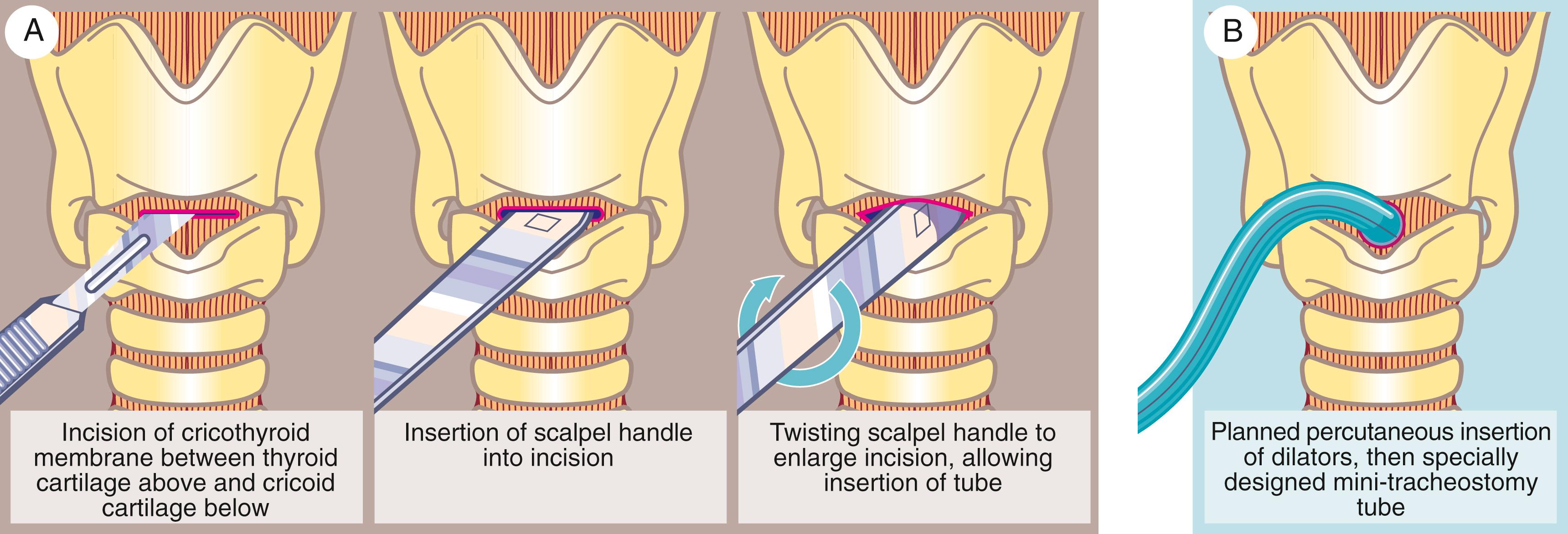 Fig. 31.4, Cricothyroidotomy.