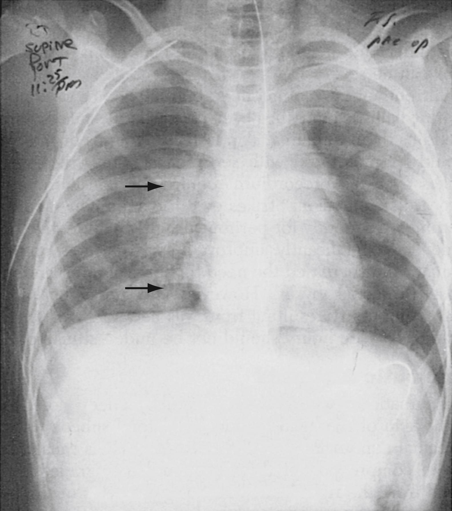 Fig. 37.2, Bilateral alveolar infiltrates (arrows) suggesting pulmonary contusion. Pneumopericardium and pneumomediastinum are also present.