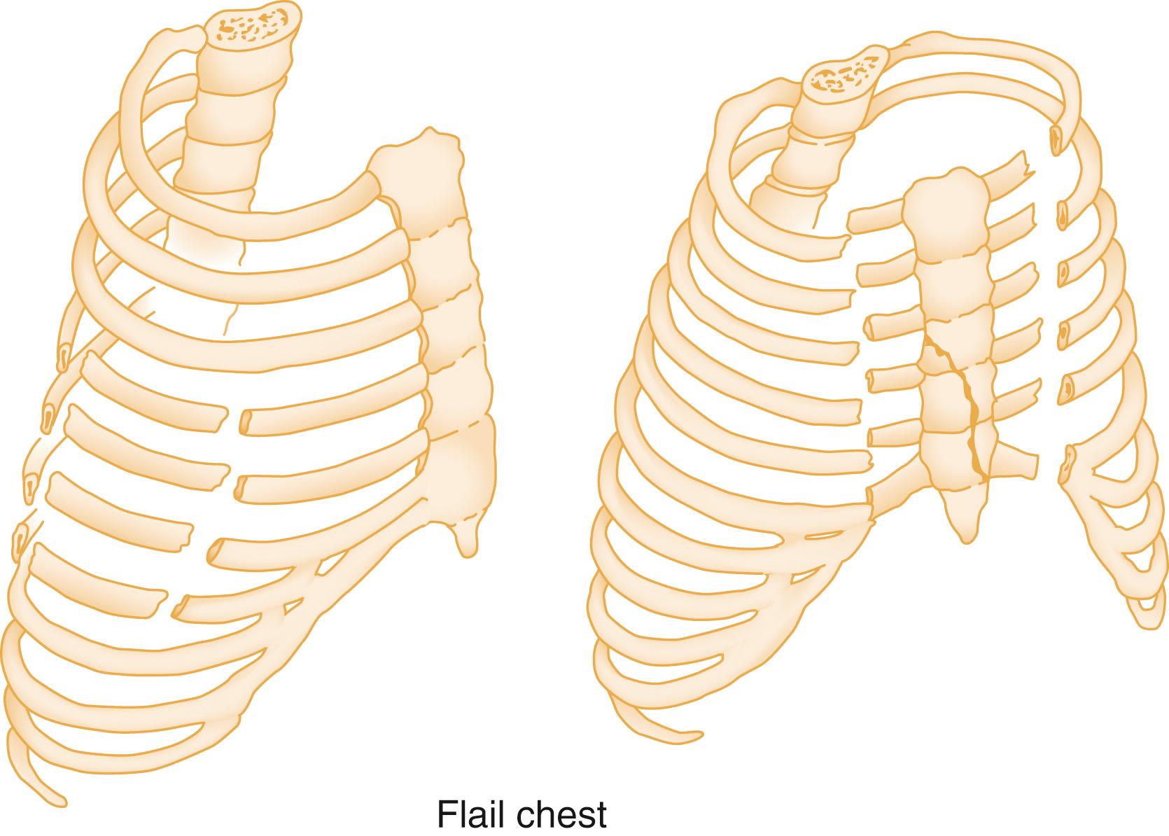 Fig. 37.1, Flail Chest.