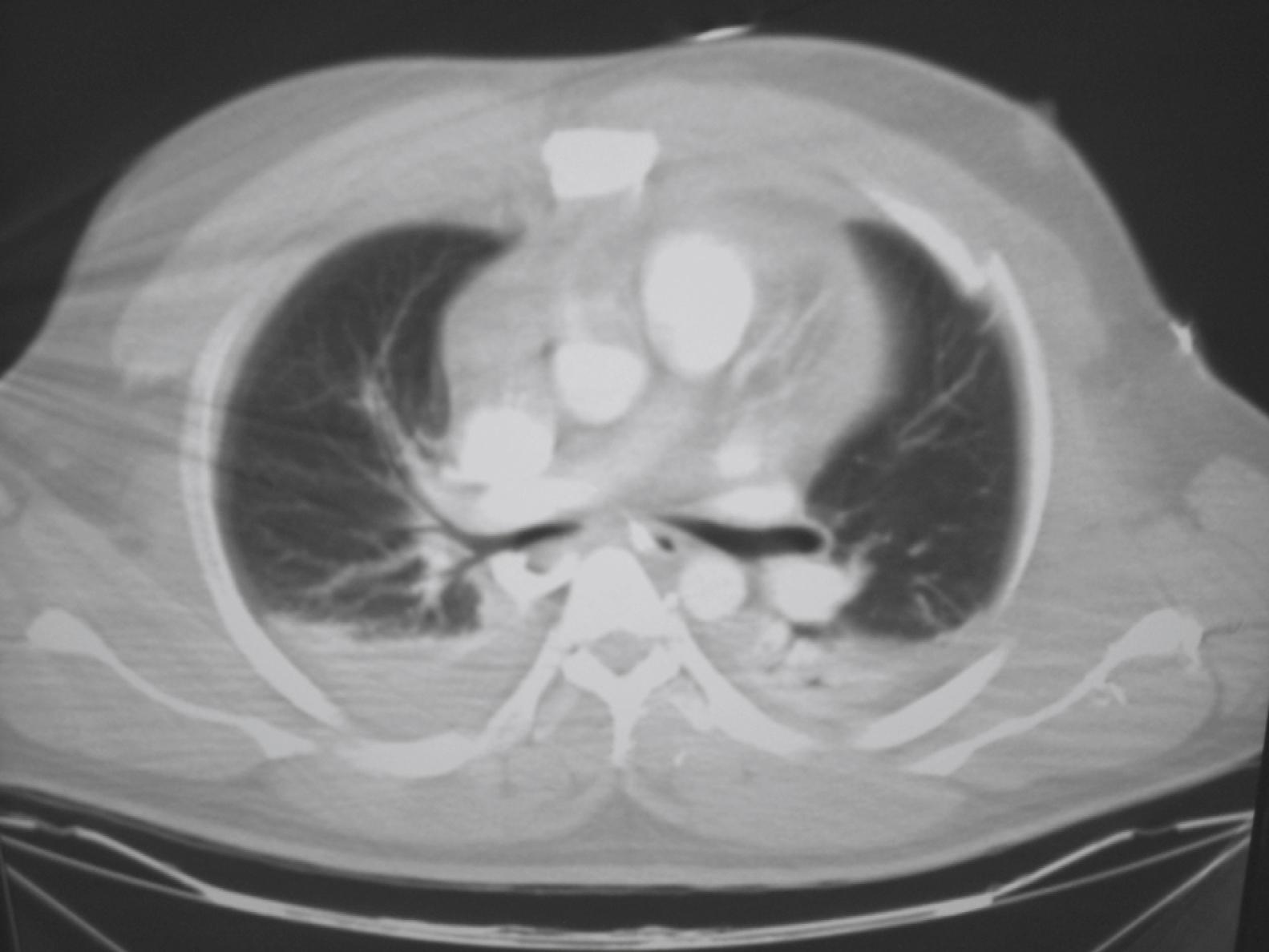 Fig. 37.3, Multiple rib fractures seen on chest computed tomography (CT) scan. (Also note presence of bilateral hemothoraces.)