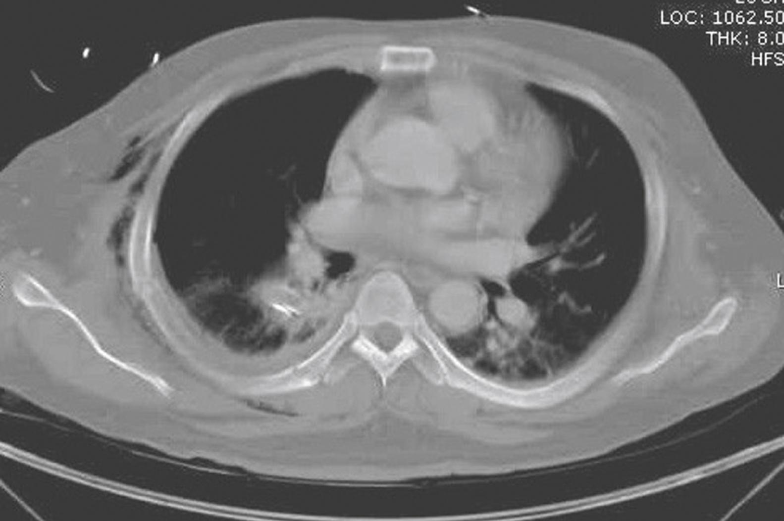 Fig. 37.4, Chest computed tomography (CT) scan showing bilateral alveolar infiltrates suggesting pulmonary contusion. There are also multiple rib fractures and subcutaneous emphysema.