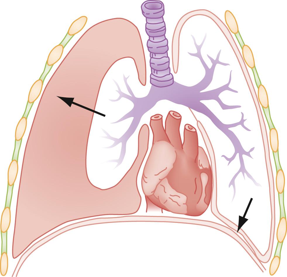 Fig. 37.5, Closed Pneumothorax.