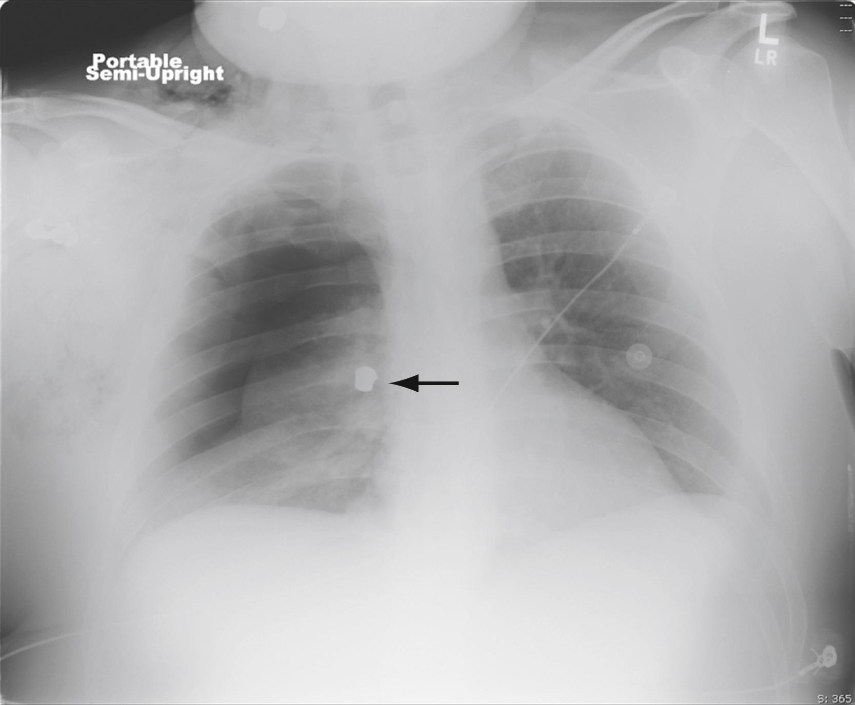 Fig. 37.6, Chest radiograph showing a moderate-sized right pneumothorax. A bullet (arrow) can be seen near the right mediastinum.