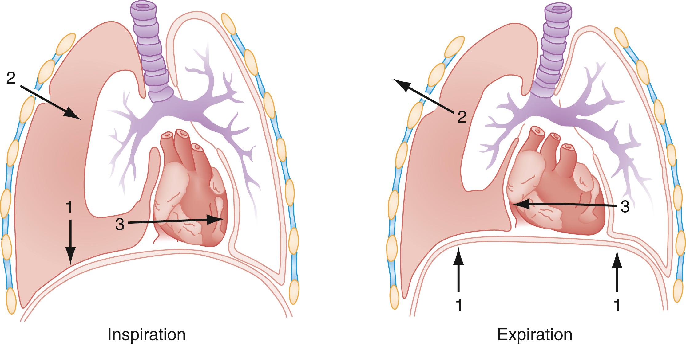 Fig. 37.7, Inspiration (left): The diaphragm contracts causing negative intrathoracic pressure (arrow 1) that draws air through the sucking chest wound in the pleural cavity (arrow 2) and causing the mediastinal structures to shift to the patient’s left (arrow 3). Expiration (right): The diaphragm recoils (arrow 1) causing air to exit the chest (arrow 2) and allowing the mediastinum to shift back to normal position (arrow 3). The collapsed lung paradoxically shrinks on inspiration and expands on expiration.