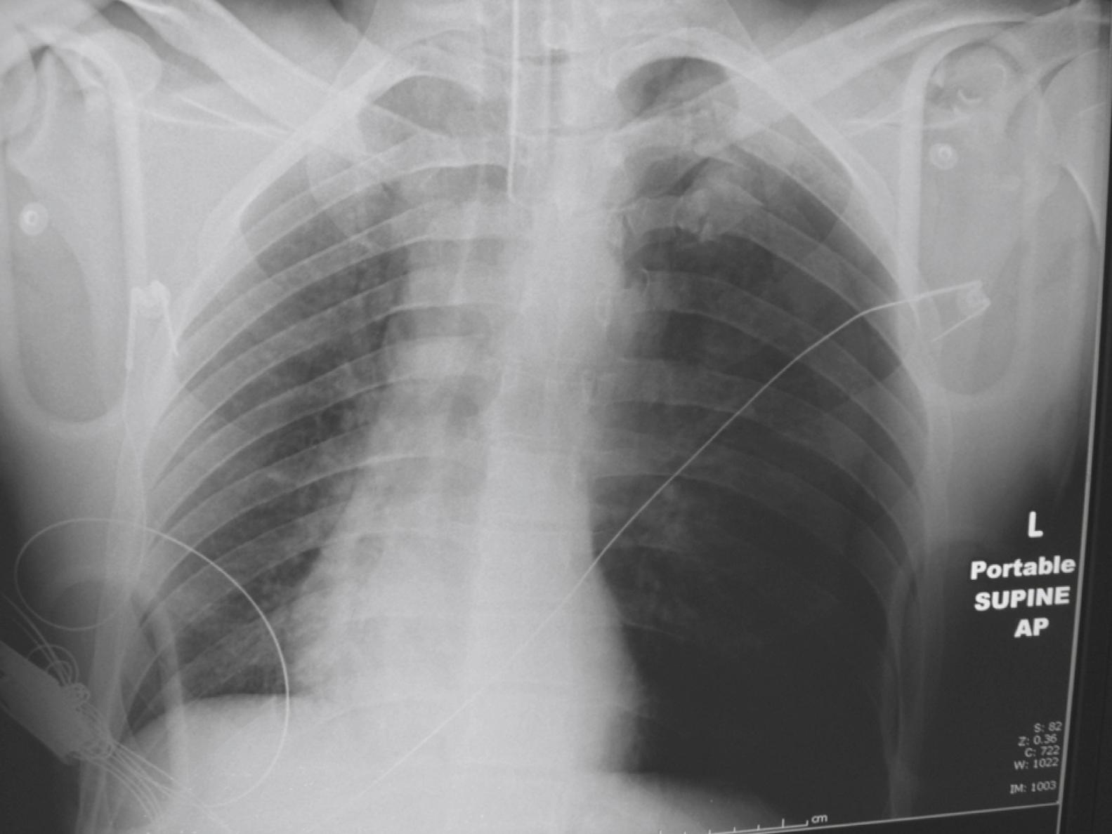 Fig. 37.8, Tension pneumothorax seen in intubated patient.