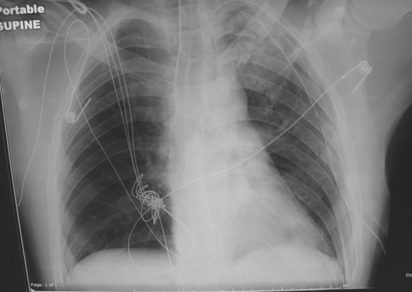 Fig. 37.9, Resolution of the tension pneumothorax shown in Fig. 37.8 with placement of a left-sided tube thoracostomy.