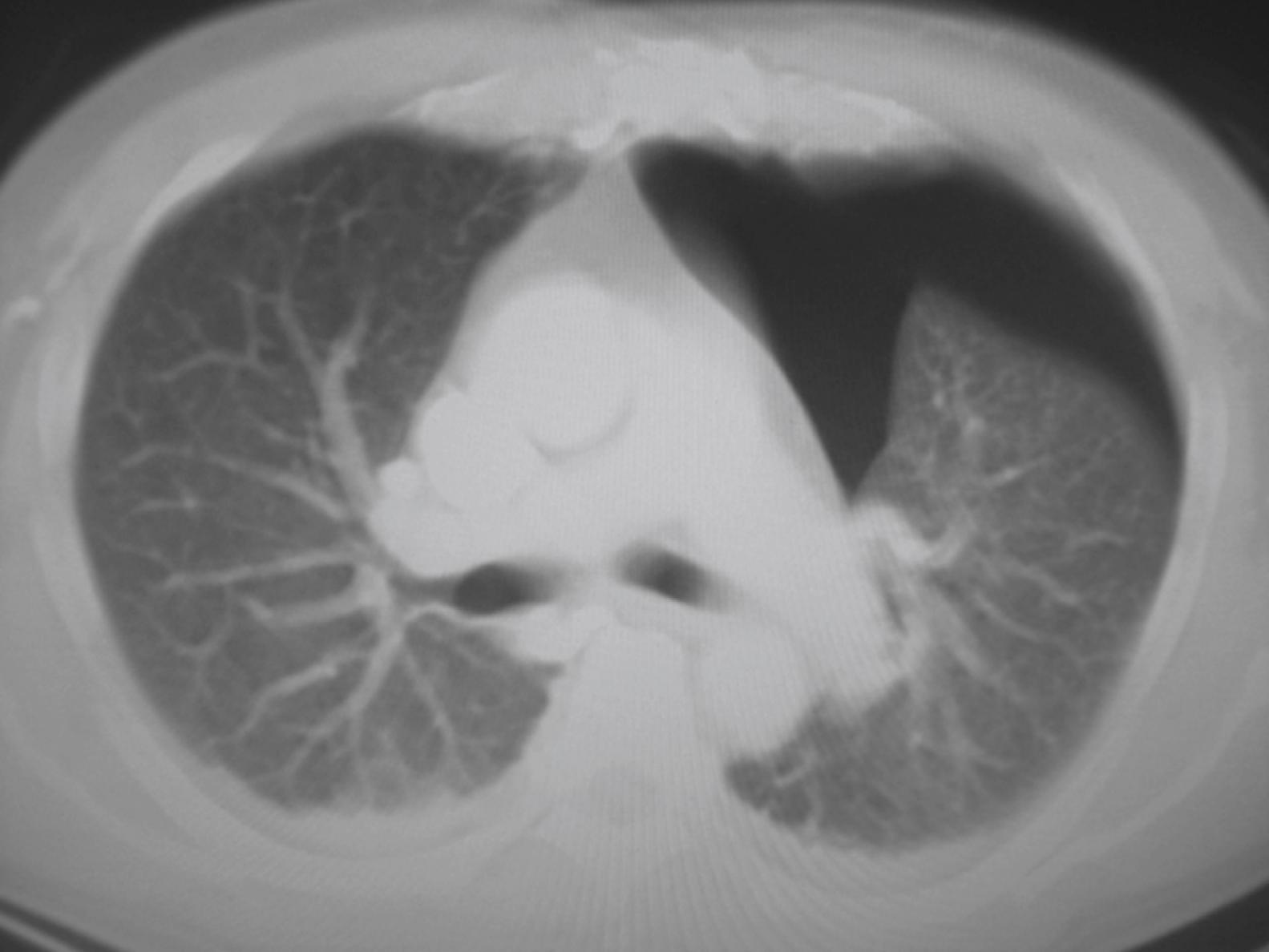 Fig. 37.10, Occult Pneumothorax.