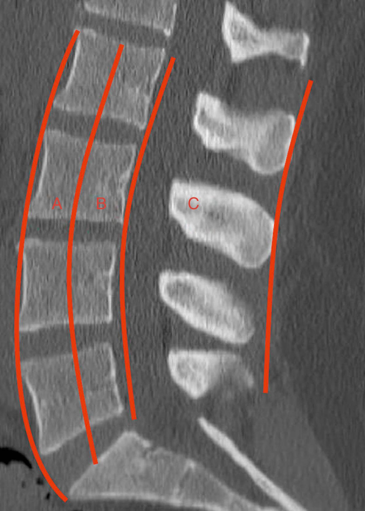 Fig. 37.1, Sagittal midline computed tomography demonstrating the anterior ( A ), middle ( B ), and posterior ( C ) columns in the Denis classification system of thoracolumbar injuries.