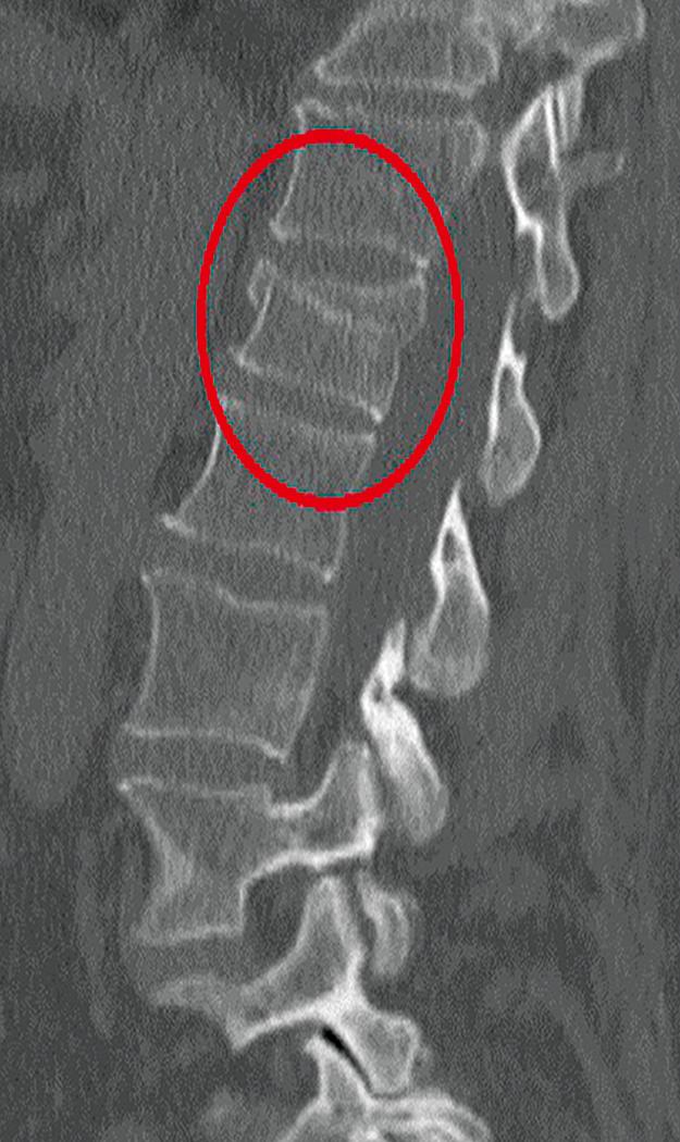 Fig. 37.2, Sagittal midline computed tomography demonstrating an L1 traumatic compression fracture. The red circle indicates where the anterior column is compressed and the middle column is intact.