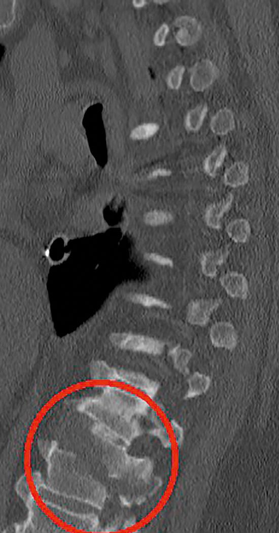 Fig. 37.4, Sagittal paramidline/midline computed tomography demonstrating a T12 Chance fracture ( red circle ), a subtype of seatbelt-type injury characterized by single-level bony injury and intact ligamentous structures.