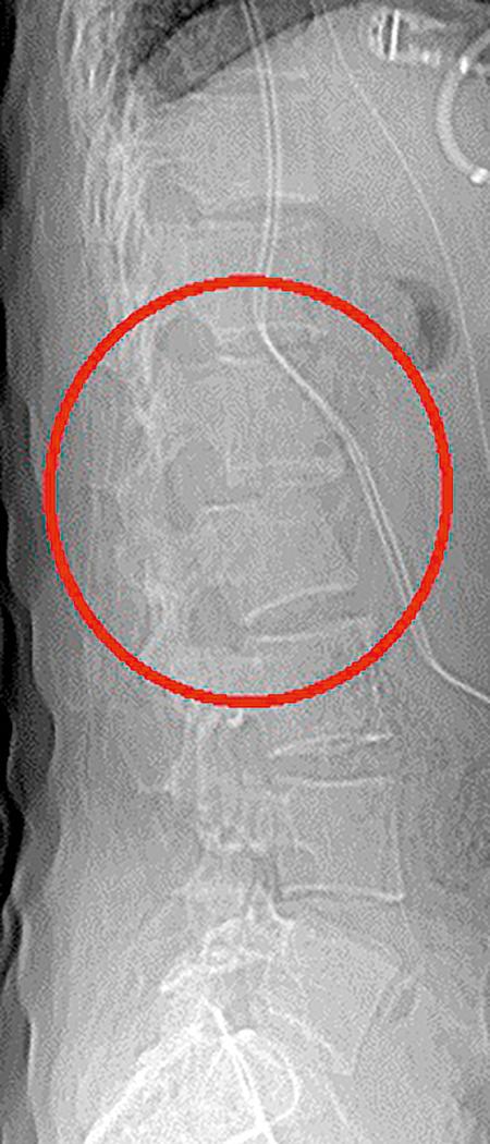 Fig. 37.5, Sagittal radiograph showing an L1‒L2 fracture dislocation-type injury ( red circle ), as described by the Denis classification.