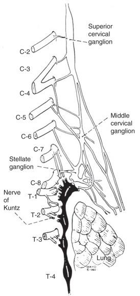 FIG 32.1, Lower cervical and upper thoracic sympathetic chain. The nerve of Kuntz, originating at the level of T2, provides direct communicating fibers to the brachial plexus.