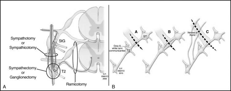 FIG 32.2, (A) Illustration of the two techniques for interrupting the sympathetic chain. (1) T1 to T2 sympathotomy has less chance of causing compensatory hyperhidrosis and axonal injury (red) from the neuron in the spinal cord. (2) Sympathectomy has a higher chance of causing axonal injury, which may also lead to neuronal injury, and more chance of causing compensatory hyperhidrosis. (B) During sympathotomy, all nerves are severed, including the nerves of Kuntz that run across the second rib between the stellate ganglion (StG) and the T2 ganglion. A, Single sympathetic trunk. B, Multiple trunks. C, Trunk with lateral nerves of Kuntz (16 patients).