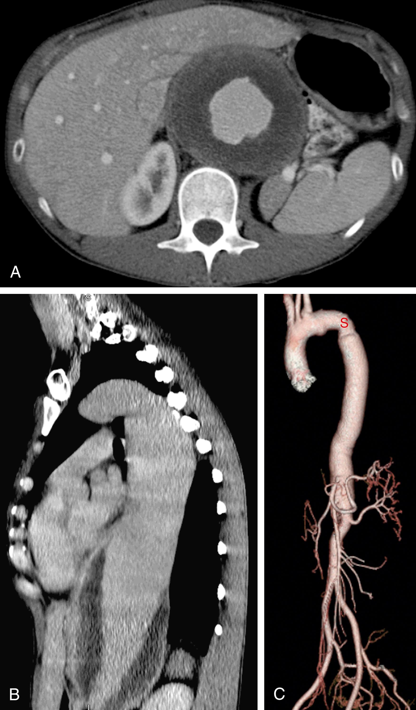 Figure 79.1, ( A,B ) A very large thoracoabdominal aneurysm in a 32-year-old woman (5’4”, 110 lbs) with no family history or stigmata of Marfan, Loeys–Dietz or Ehlers–Danlos syndromes and no elevated inflammatory markers. Presented with vague chest pain and fatigue. At repair ( C ) the proximal neck was wrapped with a Dacron sleeve to prevent future expansion. Patients like this are undefined genetically, but obviously have some molecular defect, which more than likely will be defined within the next decade from research efforts like the National Registry of Genetically Triggered Thoracic Aortic Aneurysms and Cardiovascular Conditions (GenTAC).