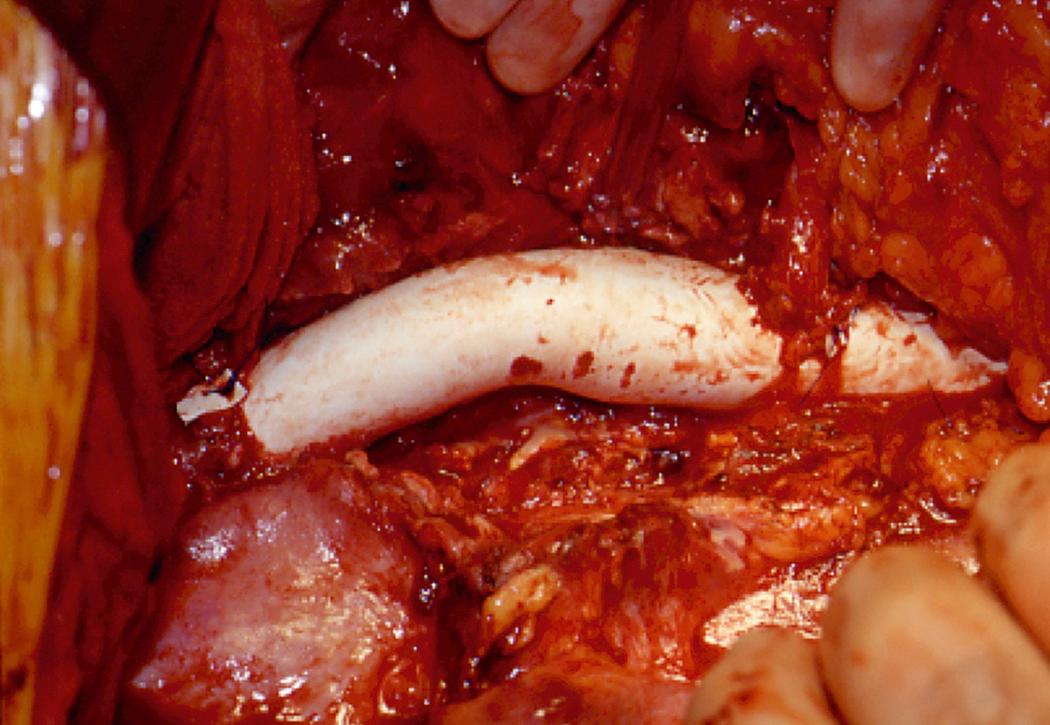 Figure 79.2, The fundamental principle in mycotic thoracoabdominal aneurysm is radical debridement of all infected aortic and periaortic tissue as seen here in a patient who developed a mycotic thoracoabdominal aneurysm from an E. coli urinary tract infection and required debridement of the distal third of the thoracic and all of the abdominal aorta with in situ aortic reconstruction using a Teflon graft.