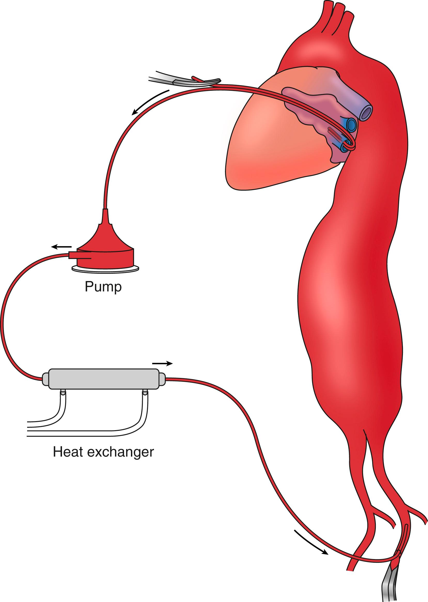Figure 79.3, Left heart bypass is the most commonly used technique of assisted circulation and is dependent on the lungs for oxygenation and the heart as the primary pump. The circuit is from the left atrium via direct cannulation or through the pulmonary vein to a centrifugal pump back into the arterial circulation (most commonly the femoral artery).