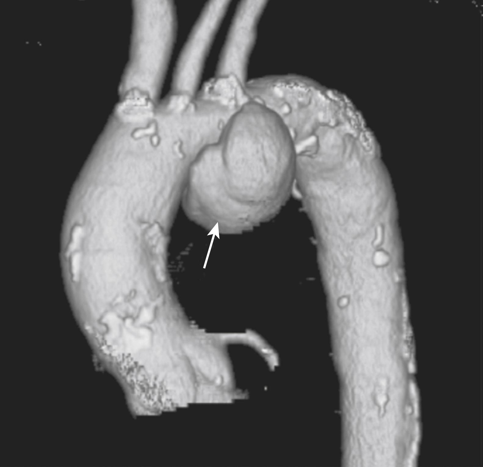 Figure 78.1, Saccular, Mycotic Thoracoabdominal Aortic Aneurysm.