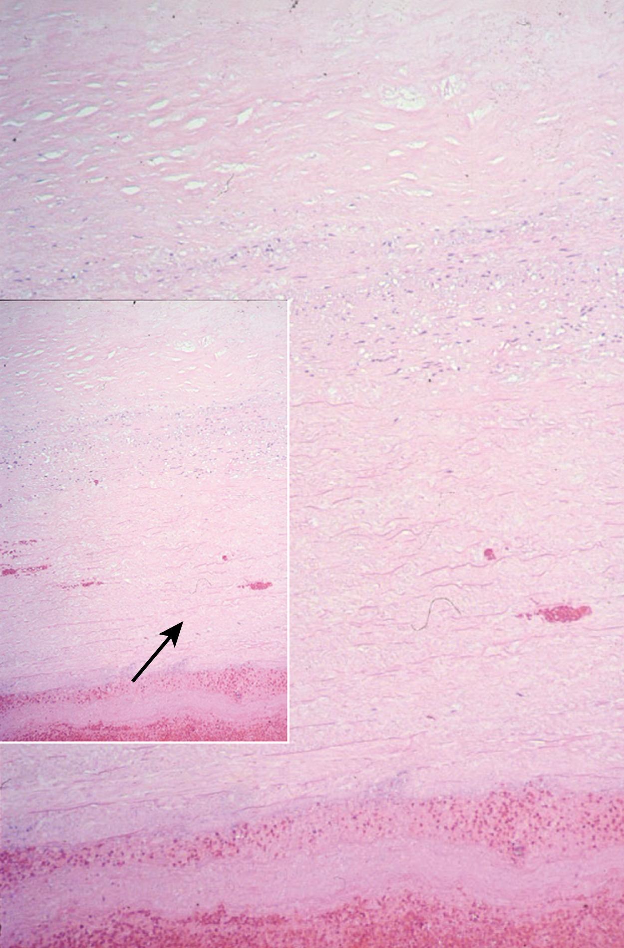 Figure 78.3, Documentation of medial degeneration and fragmented elastin (see inset , arrow ) by histology (hematoxylin and eosin, × 100) of an aortic section in a patient with a thoracoabdominal aortic aneurysm.