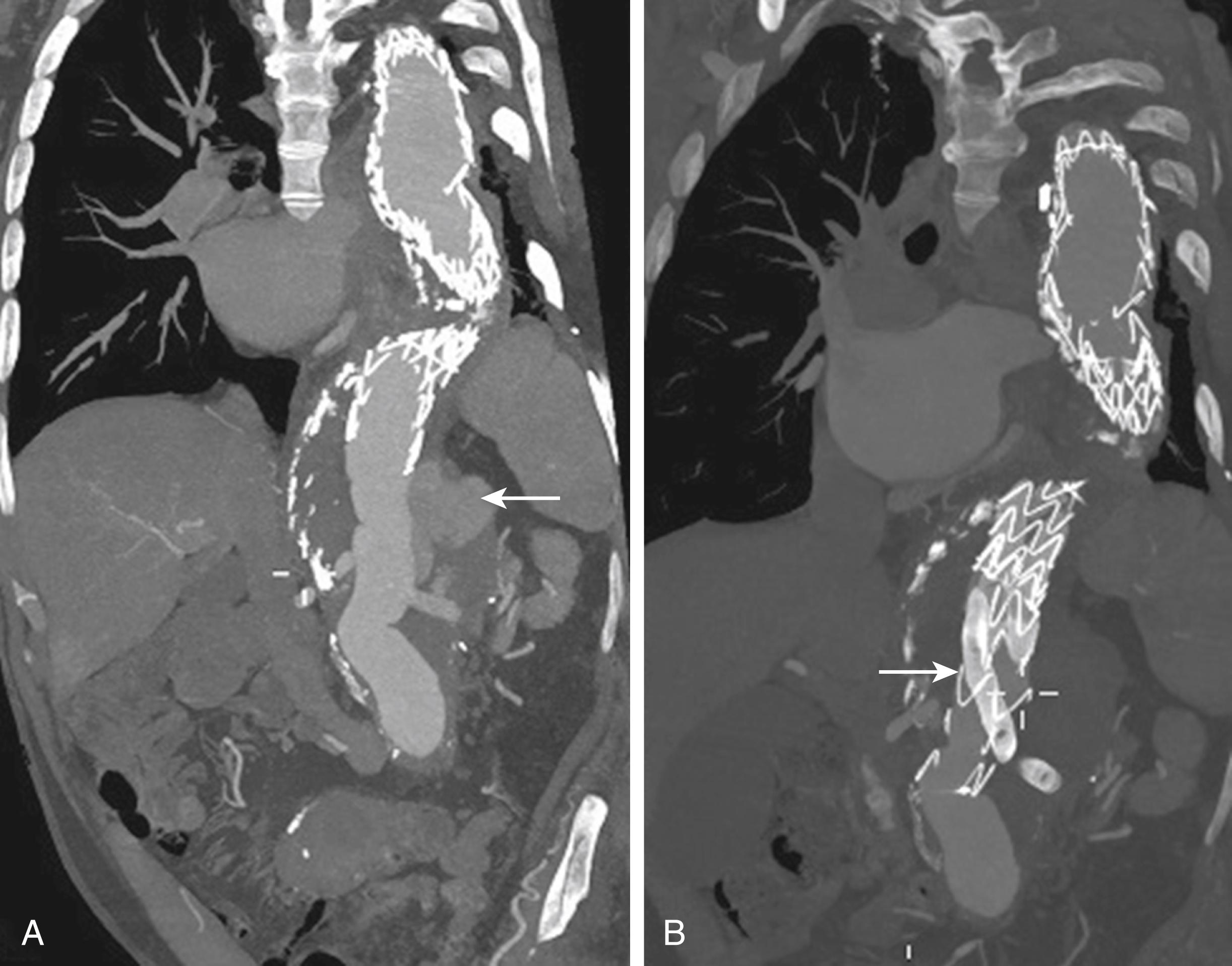 Figure 78.4, Patient with Marfan syndrome–who had previously undergone open thoracic aortic aneurysm repair, open thoracoabdominal aneurysm repair through redo thoracoabdominal approach, and thoracic endovascular aortic aneurysm repair–presented with para-anastomotic pseudoaneurysm ( A , arrow ) and was successfully treated with a snorkeled exclusion of his pseudoaneurysm ( B , arrow marks the celiac trunk snorkel).