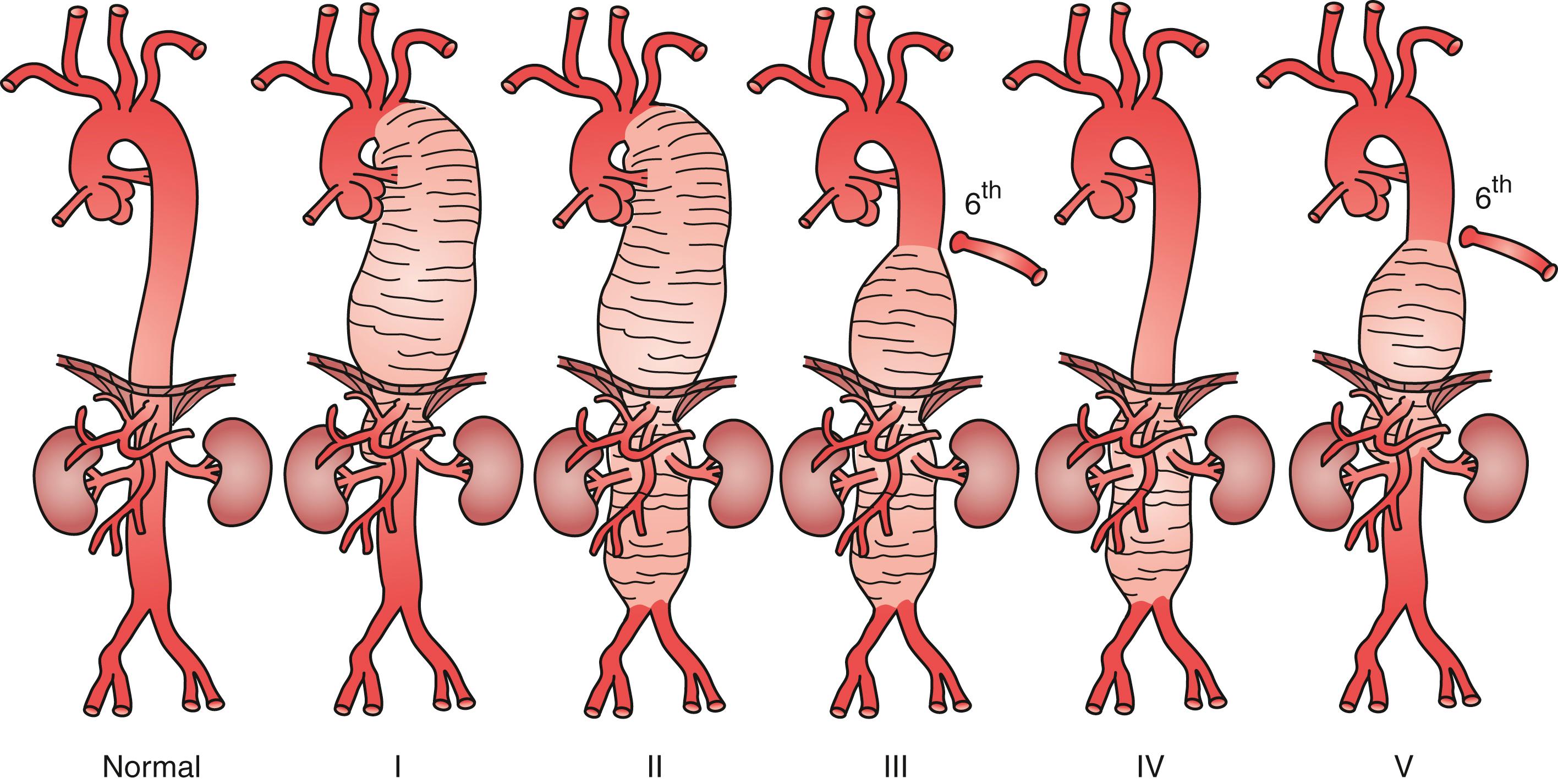 Figure 78.5, Crawford Classification of Thoracoabdominal Aortic Aneurysms.