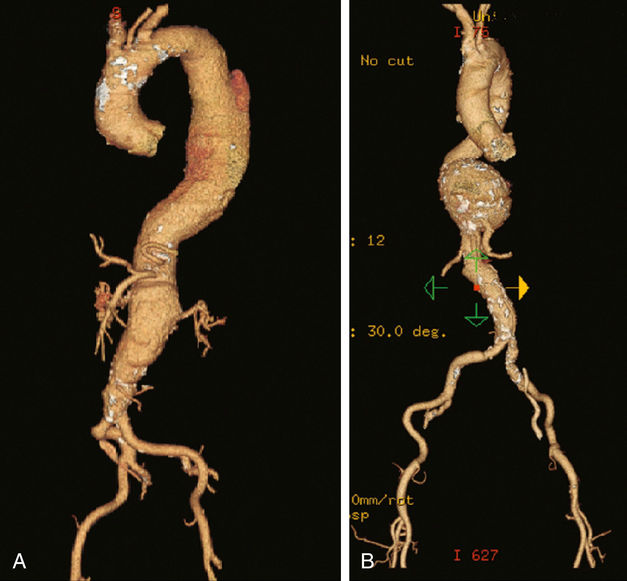 Figure 78.6, Three-dimensional computed tomography angiogram of a type II thoracoabdominal aortic aneurysm (TAAA) ( A ) with associated dissection and a type III saccular TAAA ( B ).