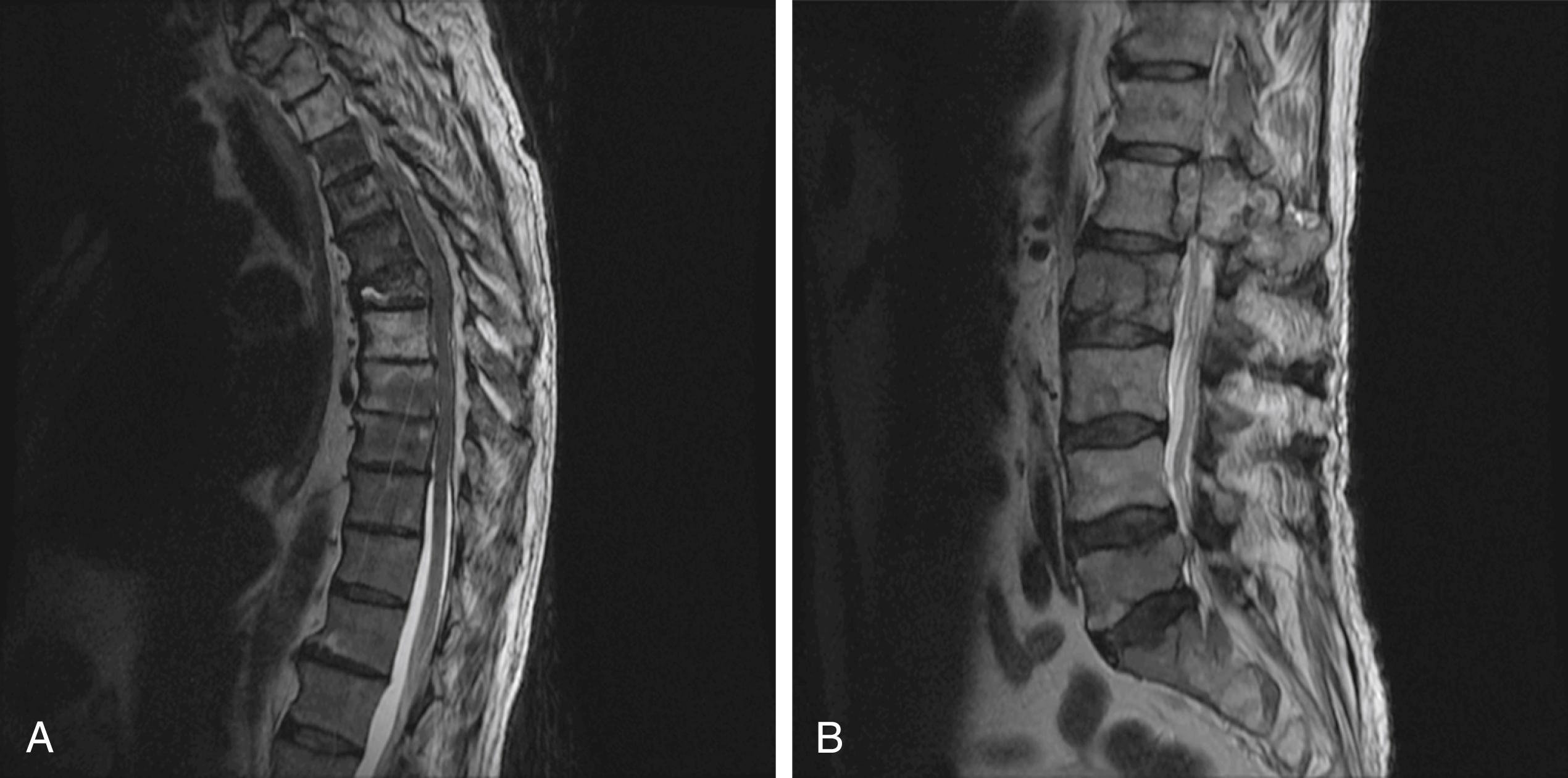 Fig. 157.2, In Weinstein’s classification system, tumors were defined as intraosseous ( A ) or extraosseous ( B ).