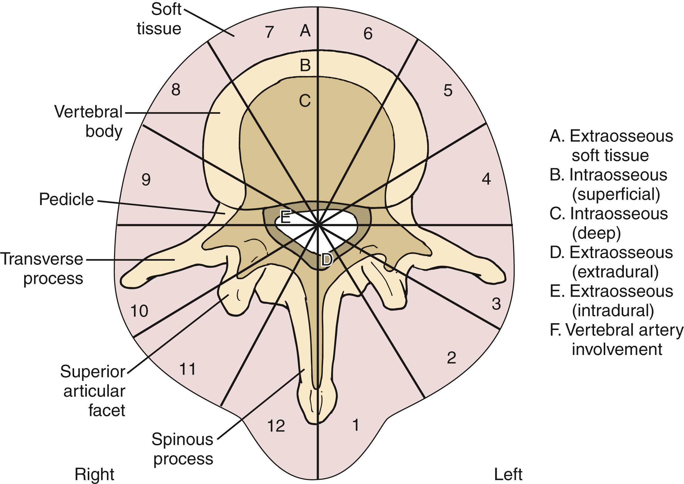 Fig. 157.3, This classification system divides tumors by vertebral location. 15