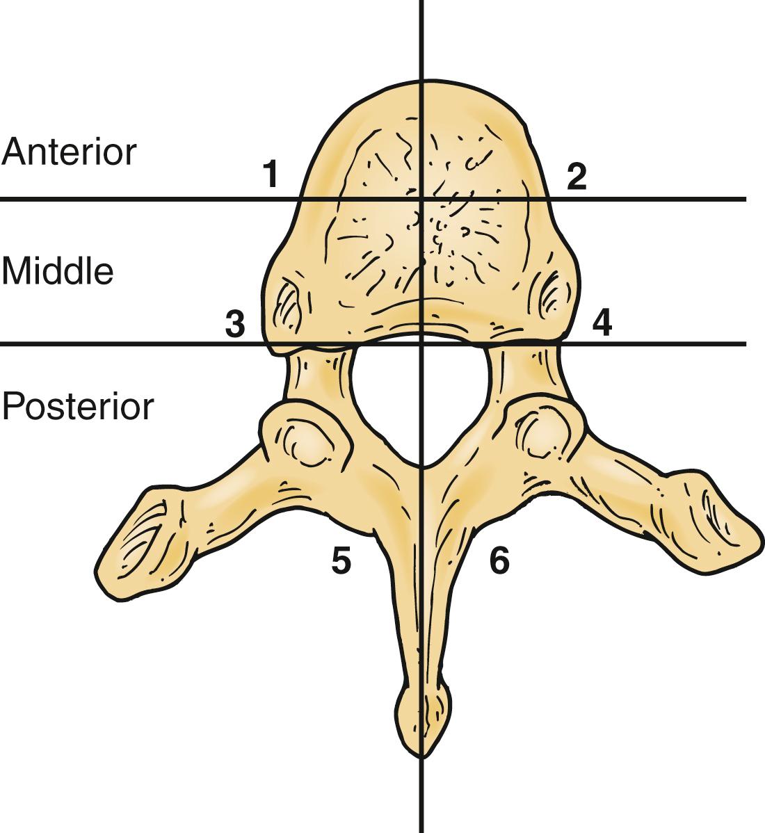 Fig. 157.4, Regions of bony destruction described by Kostuik and Errico. This classification system divides tumors by the extent of vertebral involvement. The more zones occupied by tumor, the less stable the vertebral segment.