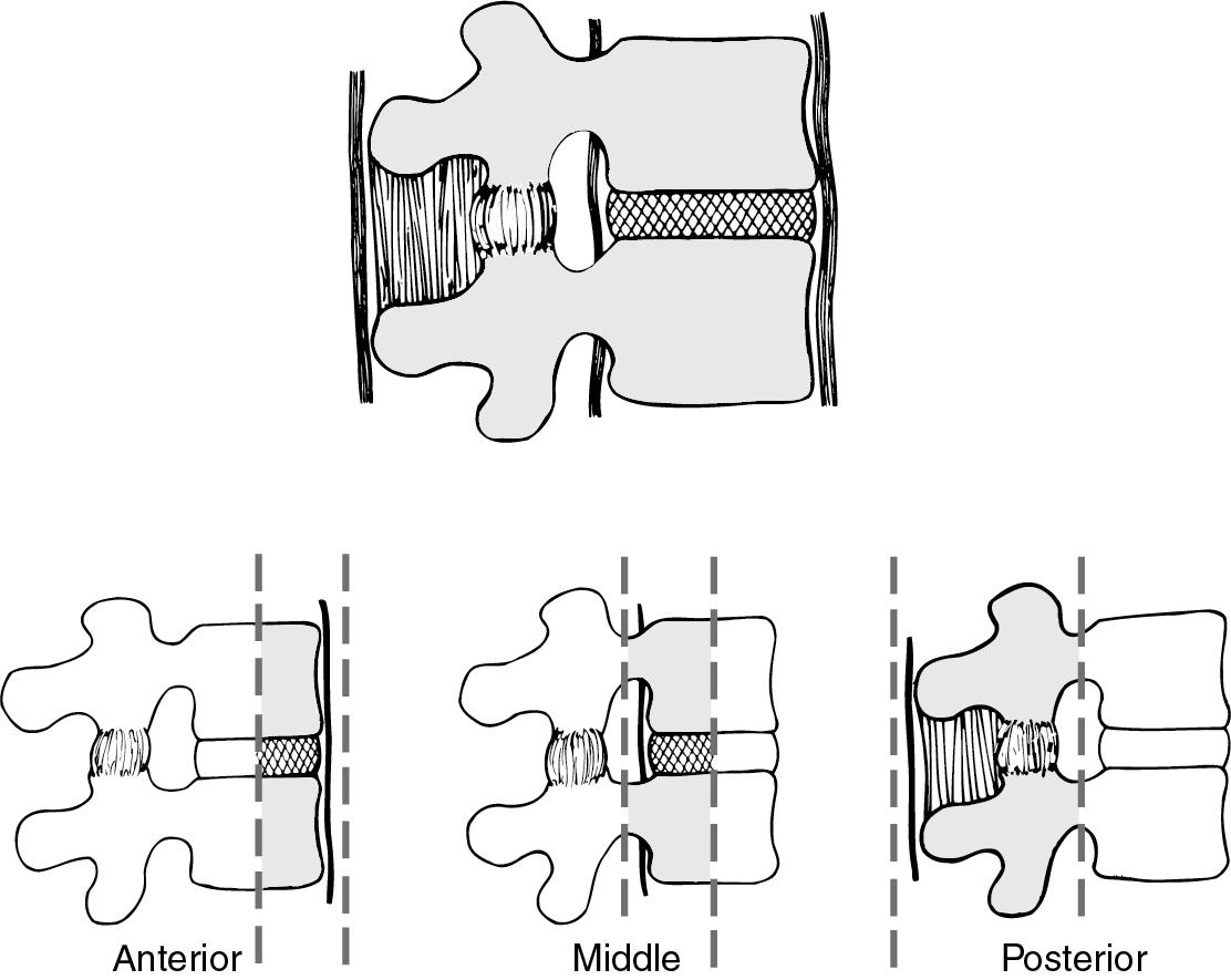 Fig. 58.1, The Denis three-column model of the spine.
