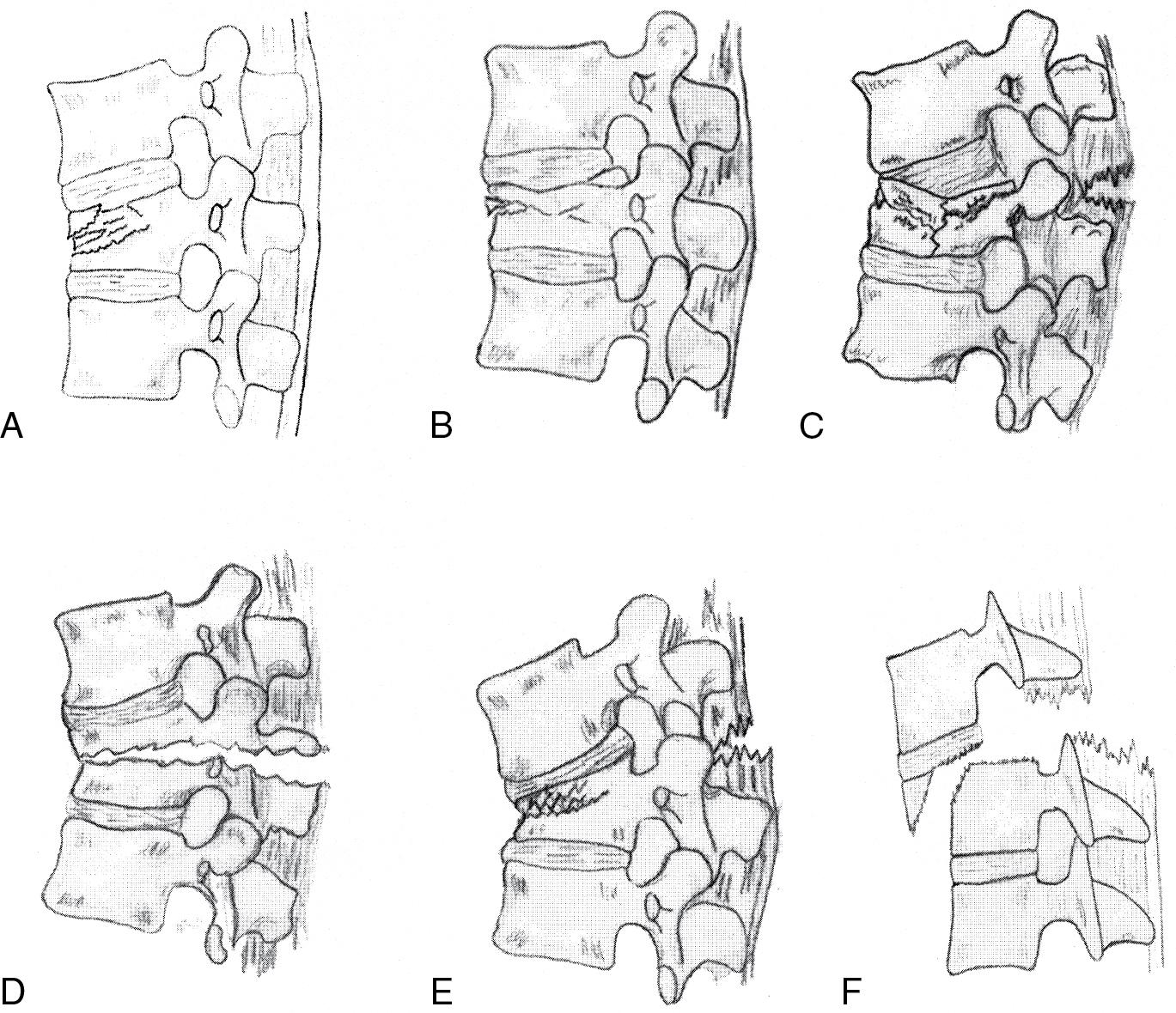 Fig. 58.2, McAfee classification of thoracic and lumbar fractures.