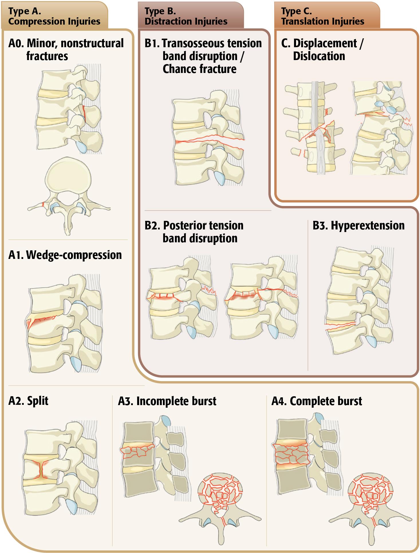 Fig. 58.3, AOSpine Thoracolumbar Classification.