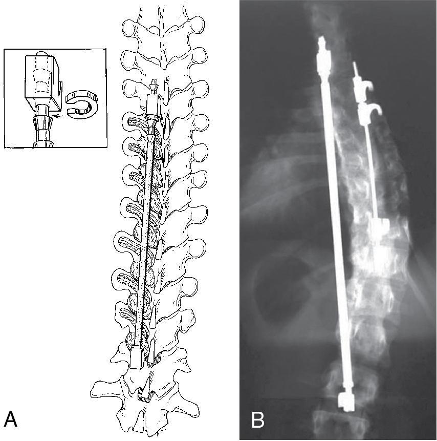 Fig. 29.2, (A and B) Harrington instrumentation.