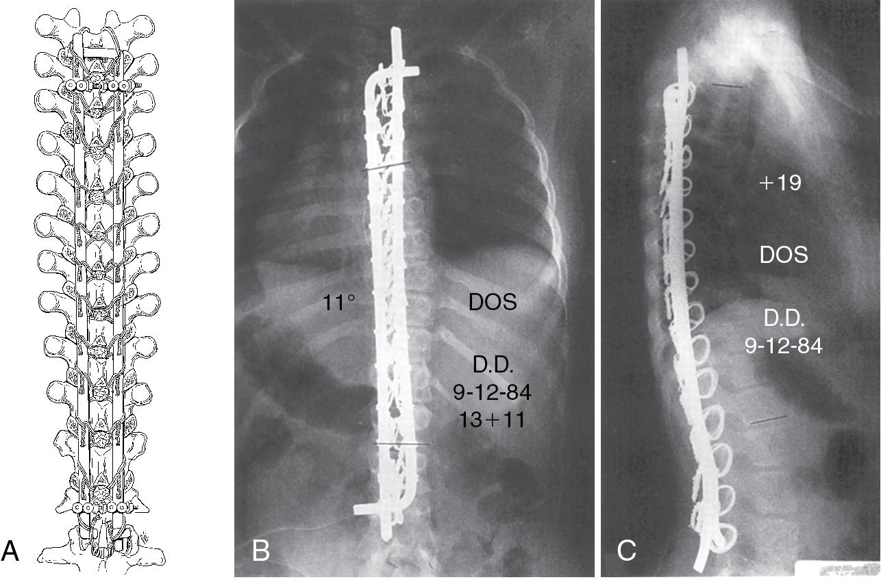 Fig. 29.3, (A–C) Luque instrumentation.