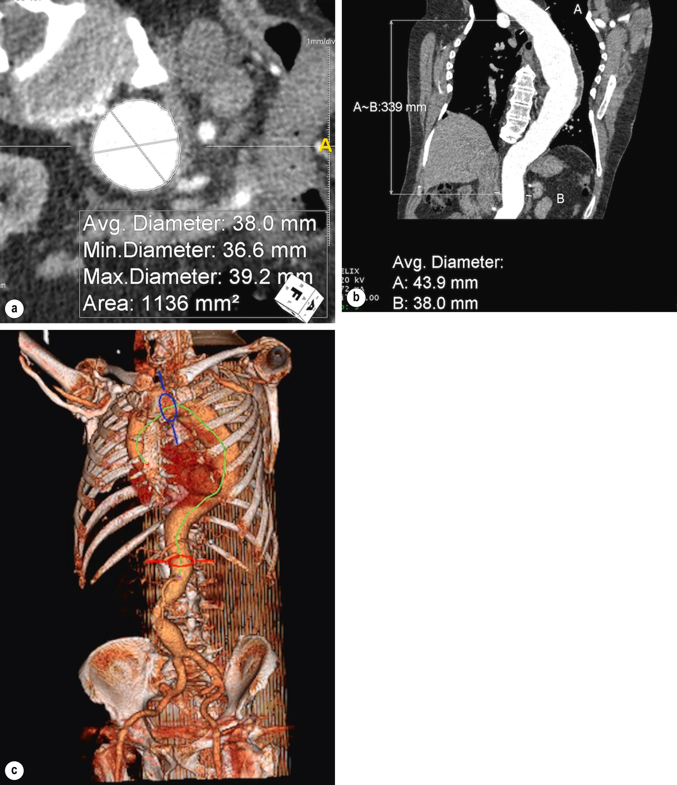 Figure 14.1, Planning thoracic endovascular intervention using images produced by reconstruction of computed tomography angiographic images of the thoracic aorta. This allows more accurate measurements of lengths and diameters, vital when selecting suitable devices (software shown produced by Terarecon, CA, USA).
