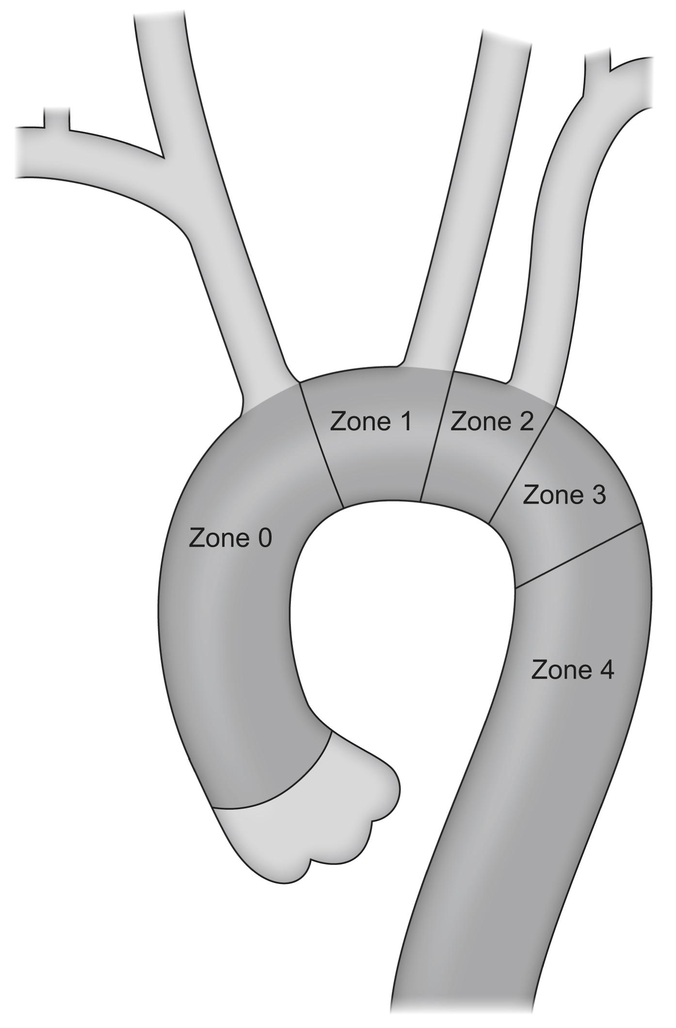 Figure 14.2, Ishimaru zones describing the proximal extent of the stent-graft landing zone required to achieve an adequate proximal seal.