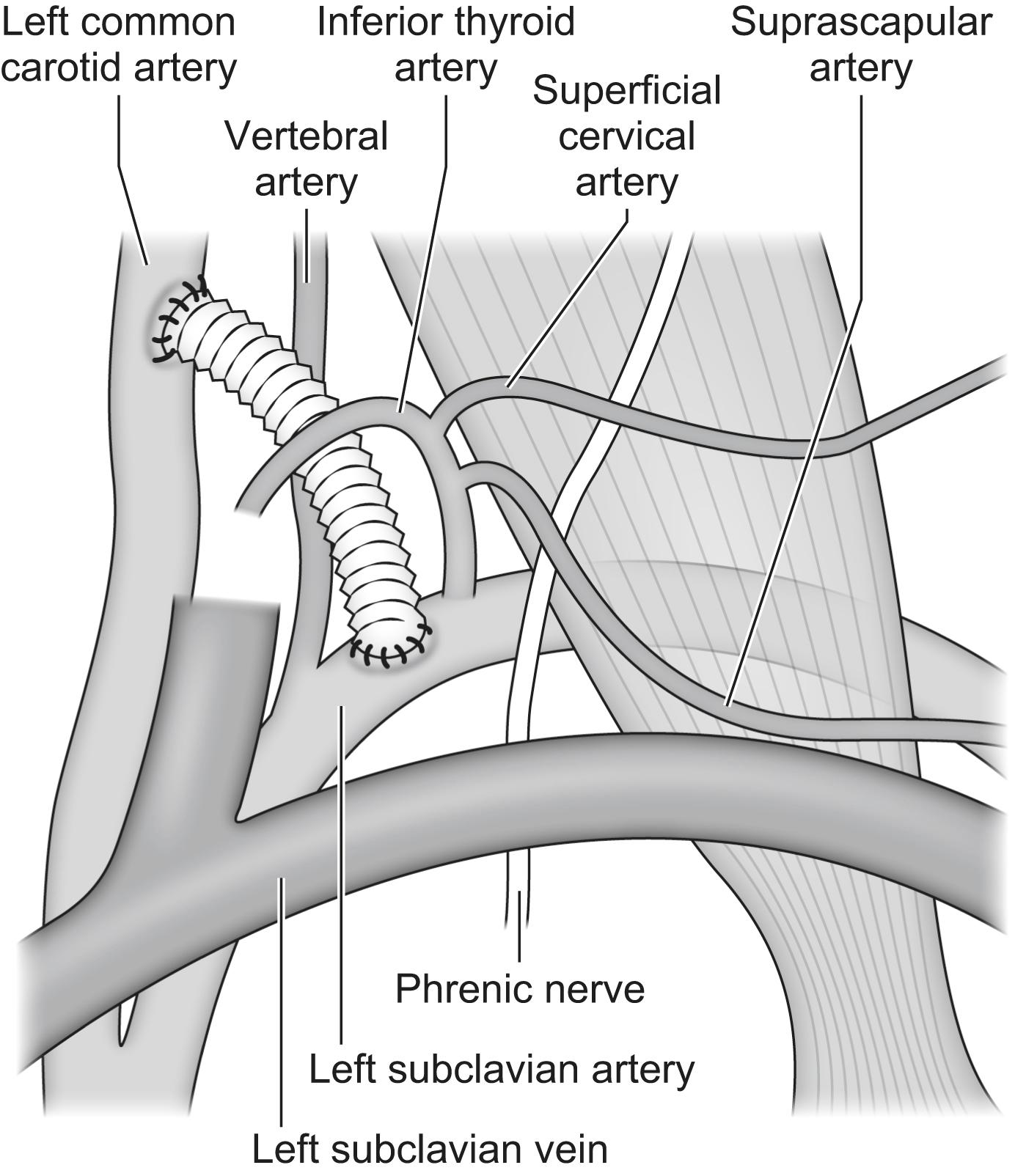 Figure 14.3, Carotid subclavian bypass performed selectively before thoracic endovascular aortic repair (TEVAR) where coverage of the origin of the vessel is required.