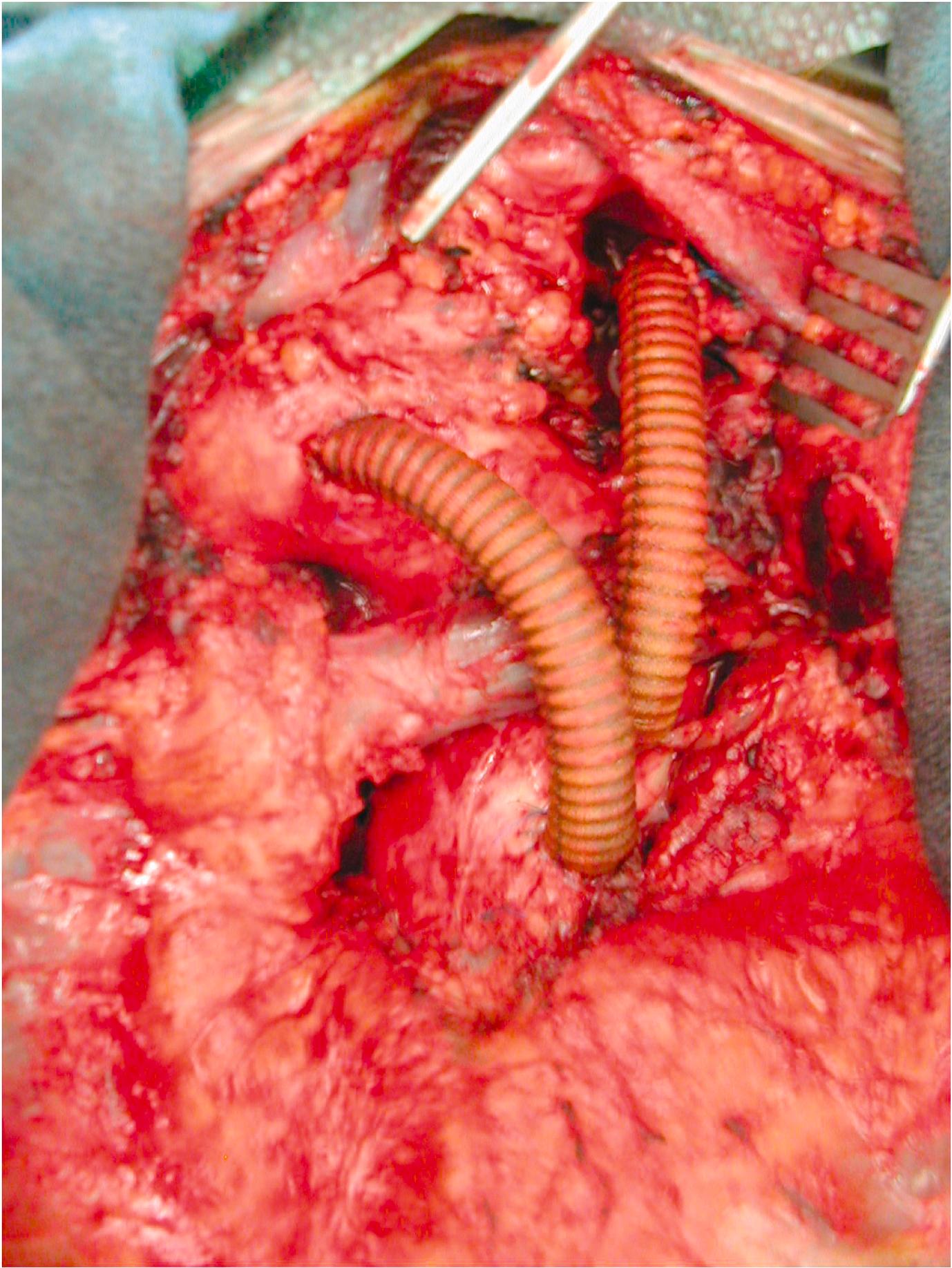 Figure 14.4, Operative photograph of ascending aorta to innominate and left common carotid. Surgery performed to create an adequate landing zone in a patient with a very proximal thoracic aneurysm.