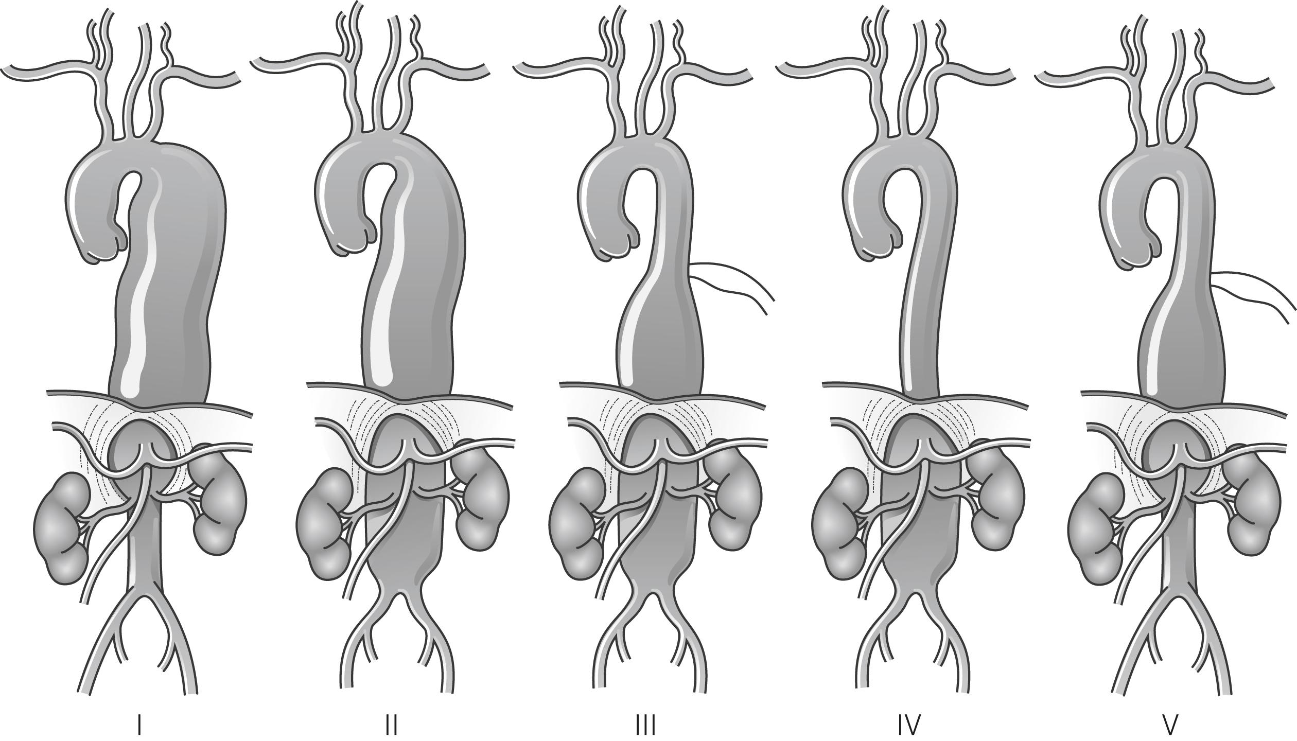 Figure 14.6, Crawford classification of thoraco-abdominal aneurysms.