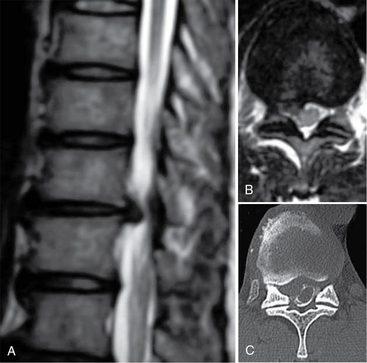 Fig. 46.1, Preoperative imaging demonstrating a right paracentral disc herniation at the T11–T12 level. (A) T2-weighted sagittal view of magnetic resonance imaging (MRI). (B) T2-weighted axial view of MRI. (C) Computed tomography myelogram.