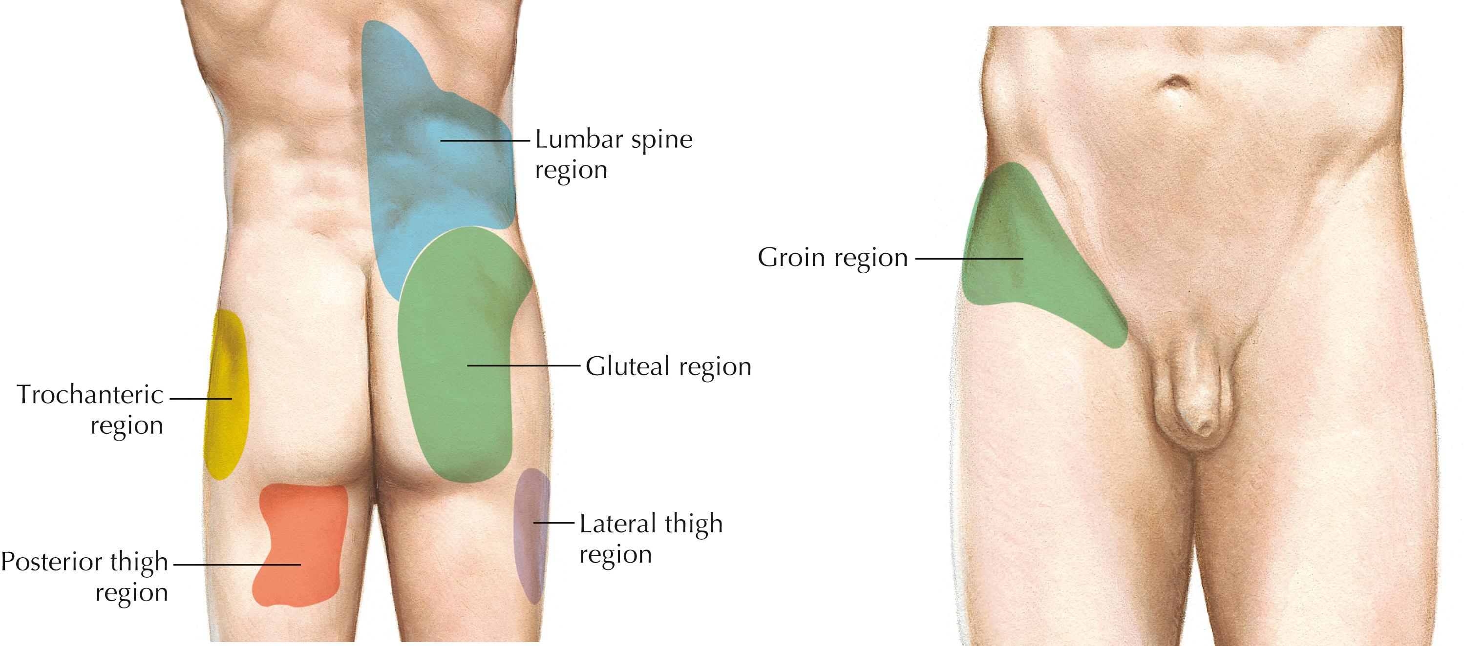 Figure 4-17, Lumbar zygapophyseal joint pain referral patterns. Zygapophyseal pain patterns of the lumbar spine as described by Fukui and colleagues. Lumbar zygapophyseal joints L1-L2, L2-L3, and L4-L5 always referred pain to the lumbar spine region. Primary referral to the gluteal region was from L5-S1 (68% of the time). Levels L2-L3, L3-L4, L4-L5, and L5-S1 occasionally referred pain to the trochanteric region (10% to 16% of the time). Primary referral to the lateral thigh, posterior thigh, and groin regions was most often from L3-L4, L4-L5, and L5-S1 (5% to 30% of the time).