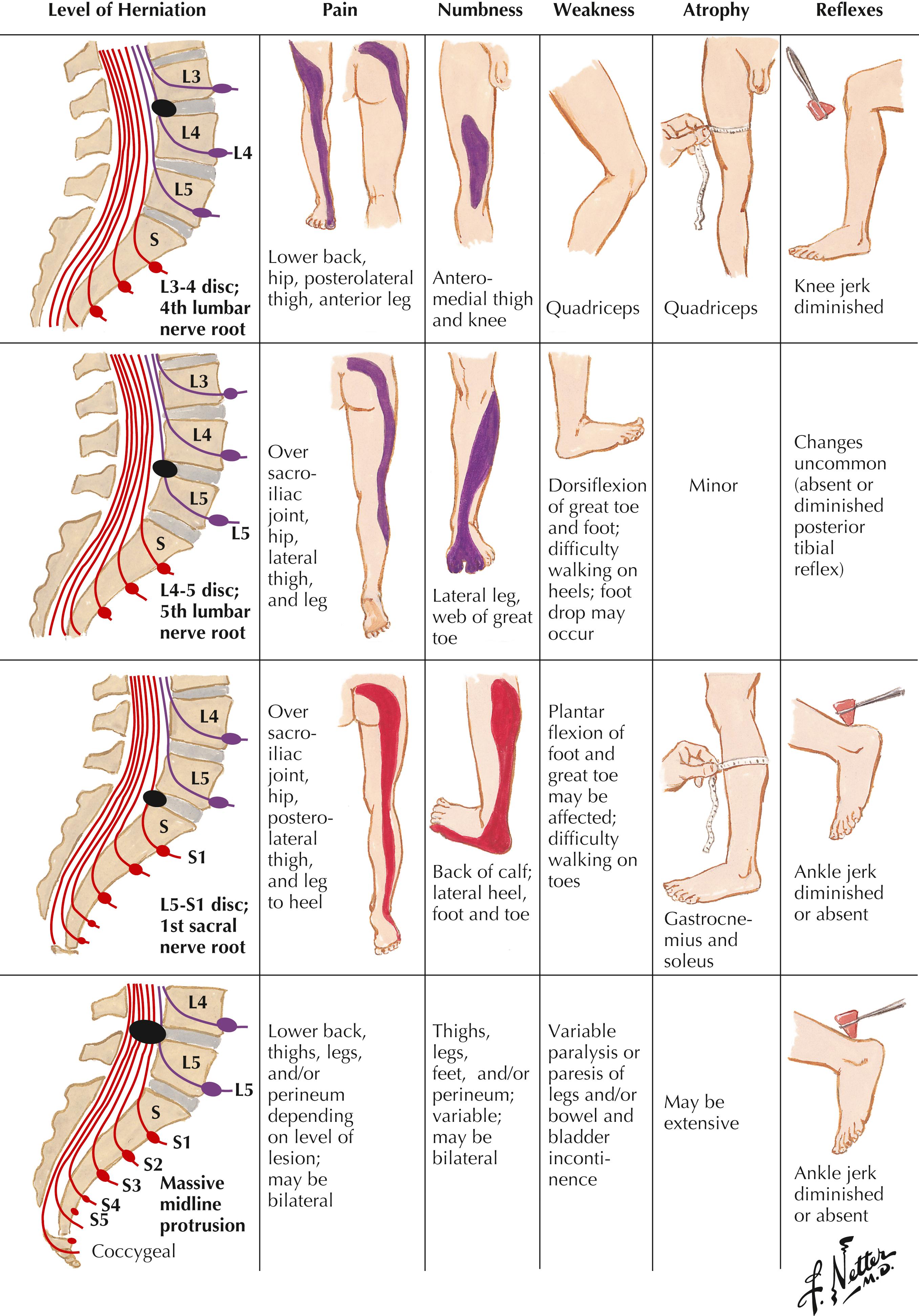 Figure 4-20, Clinical features of herniated lumbar nucleus pulposus.