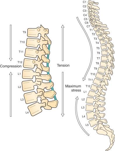 Figure 30.1, Transfer of stress forces to the thoracolumbar junction. Biomechanical transfer of energy places the thoracolumbar junction under increased stress, resulting in a high incidence of fractures compared to other areas of the thoracic and lumbar spine.