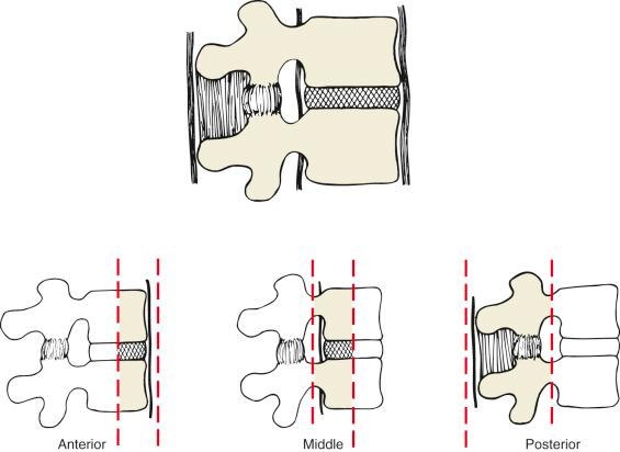 Fig. 33.1, Denis's three-column model of the spine. The middle column is made up of the posterior longitudinal ligament, the posterior annulus fibrosus, and the posterior aspects of the vertebral body and disc.