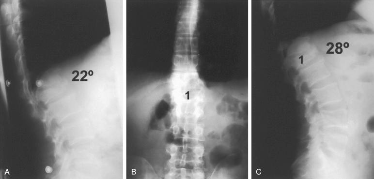 Fig. 33.2, (A) Lateral computed tomography (CT) sagittal reconstruction demonstrating an AOSpine Classification type A4 L2 burst fracture with significant canal compromise in a 34-year-old man who fell from a tree. (B) Anterior-posterior (AP) and (C) lateral plain upright radiographs after short-segment fixation with pedicle screw placement at the fracture segment.