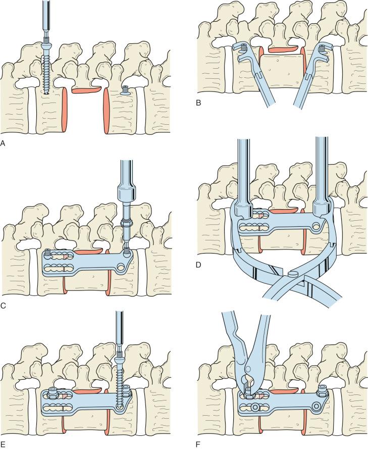 Fig. 33.4, Technique for anterior spinal instrumentation after corpectomy. (A) After using a depth gauge directed on the exposed vertebral body, appropriately sized screw lengths are selected to engage the opposite cortex of the vertebral body. The bolts are placed parallel to the adjacent endplate to avoid intrusion into the disc space above and below the corpectomy site. (B) Distraction is applied against the bolts, allowing easy insertion of the strut graft into the corpectomy site. (C) Determination of proper length of plate via a template is important to avoid impingement of the superior or inferior disc space. Locking nuts are applied and provisionally tightened. (D) Compressive forces are applied, and locking nuts are tightened firmly. (E and F) Finally, two anterior screws are placed, and the nuts are crimped down, preventing possible backing out or loosening.