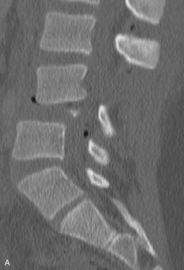 Fig. 33.5, A 10-year-old female involved in a motor vehicle accident, ASIA grade A at the T10 level. She sustained a flexion-distraction injury at the L4–L5 level with a spinal cord injury at the T12 level. Of note, she sustained significant intra-abdominal injuries, highlighting the forces sustained to the area surrounding the center of rotation. (A–C) Sagittal and left and right parasagittal computed tomography (CT) cuts, respectively, depicting an L4–L5 flexion-distraction injury with fracture through L4. (D) An axial CT cut at the L4–L5 level shows subcutaneous air consistent with extensive intra-abdominal injuries. (E and F) Sagittal and parasagittal short tau inversion recovery (STIR) magnetic resonance imaging (MRI) sequences depict disruption of the posterior ligamentous complex (PLC). A spinal cord contusion is seen at the T12 level. The patient underwent subsequent stabilization surgery.