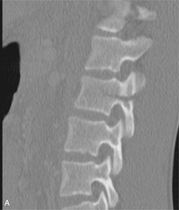 Fig. 33.6, A 14-year-old male status post–motor vehicle accident. (A–C) Left parasagittal, right parasagittal, and axial computed tomography (CT) images showing an L2 bony Chance flexion-distraction type of injury. The patient was ASIA grade E. (D) Midsagittal short tau inversion recovery (STIR) magnetic resonance imaging (MRI) sequence showing injury to the posterior ligamentous complex (PLC). (E and F) The patient underwent percutaneous reduction and fixation.