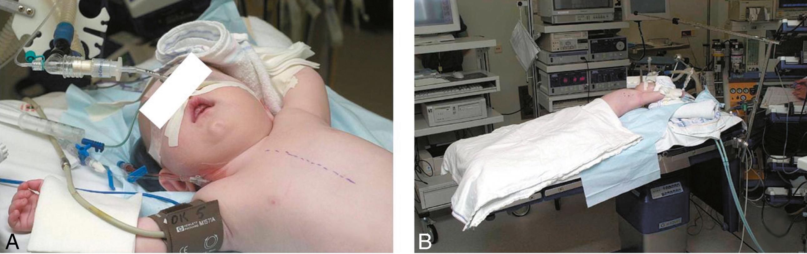 Fig. 38-1, A, The infant is placed supine on the operating table and the midsternal line is marked on the skin. B, A roll is placed under the left side of the abdomen to slightly elevate the left chest and the operating table is tilted in reverse Trendelenburg.