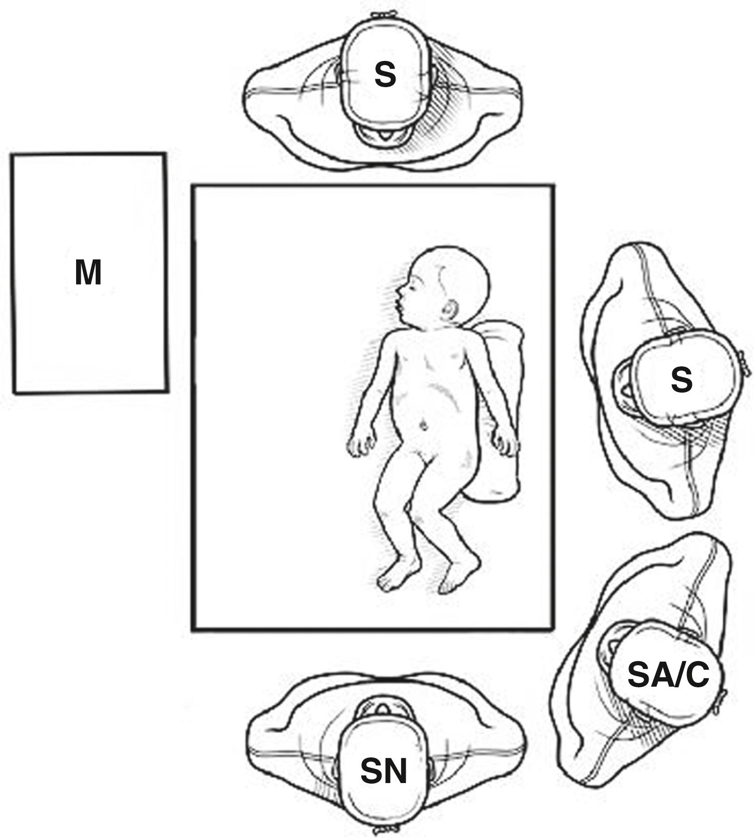 Fig. 38-2, Operating personnel are positioned as shown in the diagram. The surgeon (S) stands to the left of the infant with the assistant/camera holder (SA/C) at the surgeon’s left. The scrub nurse (SN) is at the caudal end of the short operating table. A monitor (M) is positioned to the right of the patient, keeping the aorta in line between the surgeon and the monitor. A , anesthesiologist.